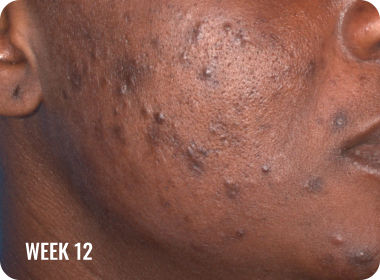 Photo of a female face with clearer skin after treatment with WINLEVI