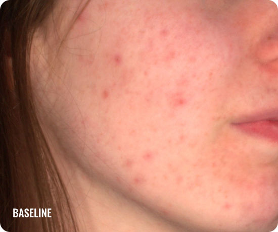 Photo of a female face with acne before treatment with WINLEVI