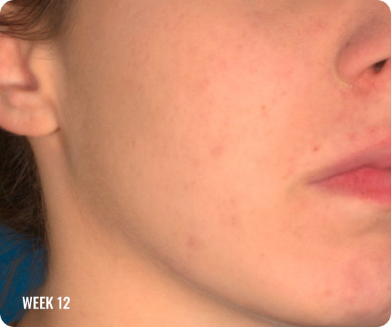 hoto of a female face with clearer skin after treatment with WINLEVI