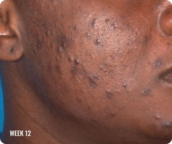 hoto of a female face with clearer skin after treatment with WINLEVI