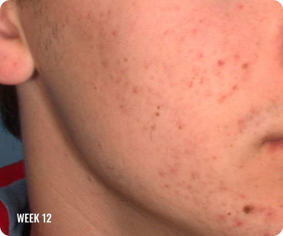 Photo of a male face with clearer skin after treatment with WINLEVI